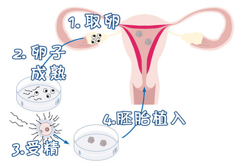 试管包生男孩医院